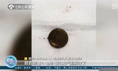 幼儿误吞电池致爆炸 云南事件警示儿童玩具与电池安全